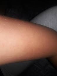 Paula's choice skincare resist skin revealing body lotion with 10. Weird Bumps On My Arms Help Beautylish