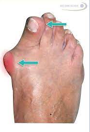 Unbehandelt beeinträchtigt ein ballenzeh nicht nur die füße. Hallux Valgus Konservativ Behandeln Oder Operieren Gelenk Klinik De