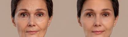 Expert Aesthetic Services Facial Rejuvenation About Face Centers