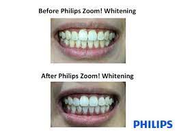 Get the best deals on teeth whitening lights. Malaysian Lifestyle Blog Philips Zoom Teeth Whitening Spa Treatment Smile Express Dental Spa
