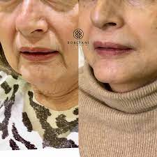 What A Transformation We Used Dermal Fillers Directly In The Marionette Lines And Corrected The Nasola Dermal Fillers Marionette Lines Marionette Lines Filler