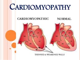 Image result for Cardiomyopathy