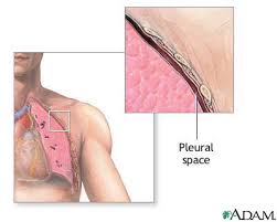 The classic description of malignant pleural mesothelioma is a thickening in the pleural space with encasement of the lung by a rindlike . Pleural Space Medlineplus Medical Encyclopedia Image
