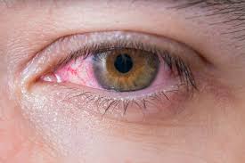 Image result for Uveitis