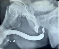 Image result for Retrograde Urethrogram