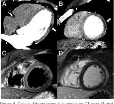 Cardiac mri is particularly useful because the iron overload directly affects magnetic resonance imaging classified as idiopathic, these cases are attributed to genetic factors, viral myocarditis. Figure 1 From Acute Myocarditis Demonstrated On Ct Coronary Angiography With Mri Correlation Semantic Scholar