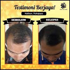 Sekarang dah semakin kurang selepas menggunakan syampu aura hijab. Pakar Rawatan Rambut Gugur Dan Botak Anda Publications Facebook