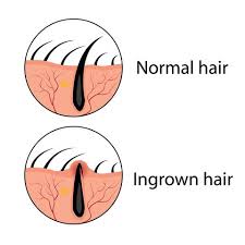 Castor oil clears the impurities in the skin and nourishes the skin the right way. How To Get Rid Of Ingrown Hair Tips For Ingrown Hair Removal