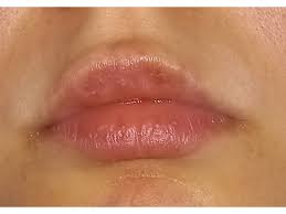 Миграция филлера