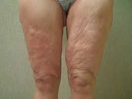 Changes Incisionless Thigh Left Pre Op Plan 19876 Loose Skin Thighs Excess Skin