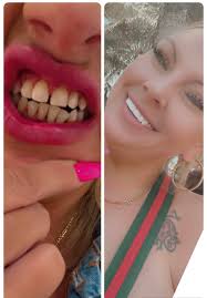 Veneers at Smile Dental Center in Miami