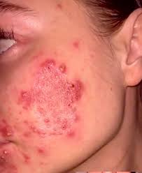 Patient presents because of this rash