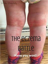 The Eczema Battle Fighting The Good Fight Eczema Eczema Causes Natural Health Tips