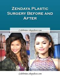 Zendaya Plastic Surgery Before And After Plastic Surgery Celebrity Surgery Celebrity Plastic Surgery