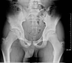 With age, the bones can become weak and brittle. Anterior Inferior Iliac Spine Avulsion Aiis Knee Sports Orthobullets