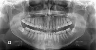 Image result for xrays in dentistry