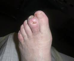 Image result for gout symptoms toe