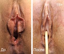 Лабиопластика: что это?