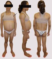 En su trabajo inicial seip8 describió. Type 2 Congenital Generalized Lipodystrophy The Diagnosis Is In Your Hands The Journal Of Pediatrics