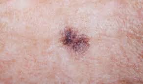 Here are 10 more facts about prostate cancer. Skin Cancer Symptoms Warning Signs Your Mole Is Melanoma How To Prevent It Express Co Uk
