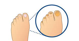 Estos Son Los 5 Problemas Mas Comunes En Las Unas De Los Pies Ceapie