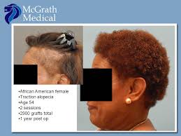 Restoring edges in black women when done right, a hair transplant surgery can produce lifelong results that are natural. Traction Alopecia Hair Transplant In Austin Tx