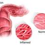 intestino colon irritable de www.alimmenta.com