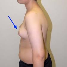 Some early cancers may have signs and symptoms that can be noticed, but that is not always the case. Male Breast Cancer Oncology Medbullets Step 2 3