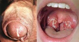 Penyakit ini dikarenakan oleh bakteri neisseria gonorrhoeae yang umumnya ditularkan lewat kontak dengan mulut. Obat Untuk Penyakit Sipilis Pada Wanita Di Apotik Terbukti Sembuh Tanya Dokter Kelamin