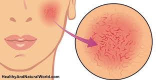 What causes broken capillaries on chest. Broken Blood Vessels On Face Causes Symptoms And Treatments