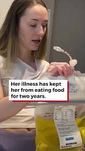 Intestinal Obstruction X Ray Story Fern