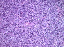 Jones s.e., fuks z., bull m. Pathology Outlines Case Of The Week 412