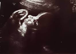 Geschlechtsbestimmung des babys per ultraschall: Ultraschallbilder Mehr Als 50 Bilder Aus Der Schwangerschaft Faminino