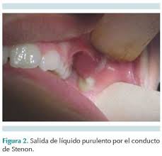 Image result for Sialoadenitis