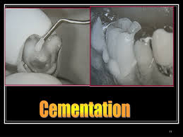Maybe you would like to learn more about one of these? Ppt Introd Uction To Dental Cements Powerpoint Presentation Free Download Id 1017175