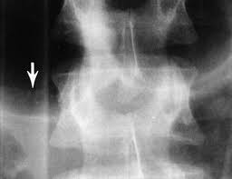 Check spelling or type a new query. Frequency And Importance Of Transverse Process Fractures In The Lumbar Vertebrae At Helical Abdominal Ct In Patients With Trauma Radiology