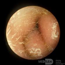 Image result for Acute Otitis Externa