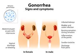 Image result for gonorrhea symptoms