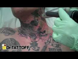 Enter a doctor name or a treatment. Tattoo Removal Of Skulls Tattoo On Neck At Dr Tattoff Laser Tattoo Removal Clinic In Houston Texas Youtube