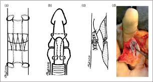 Fdp tendon repair using the nano corkscrew ® ft suture anchors damon c. Figure 1 From The Effect Of Adding Active Flexion To Modified Kleinert Regime On Outcomes For Zone 1 To 3 Flexor Tendon Repairs A Prospective Randomized Trial Semantic Scholar