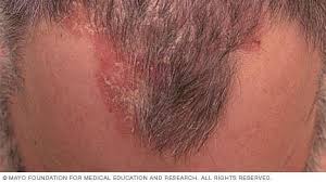 عرض الشرائح أنواع الصدفية صور الصدفية Mayo Clinic مايو كلينك
