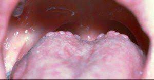 Sensitive + enamel shield, cph healthy fresh Bumps On Back Of Tongue Tongue Sores Bumps On Tongue Tongue Health