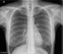 Nov 08, 2017 · primary spontaneous pneumothorax: Delayed Spontaneous Bilateral Pneumothorax In A Previously Healthy Nonventilated Covid 19 Patient Journal Of Emergency Medicine