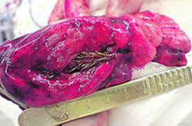 This is pushed out of the lungs by tiny hairs called cilia. Too Strange To Be True Tree Found Growing In Man S Lung Discover Magazine