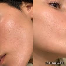 Keratosis pilaris is a common skin condition where small bumps develop on the arms, legs or buttocks. Oily Skin Closed Comedones Keratosis Pilaris Or Something Else Causing Bad Texture Skincare Addiction