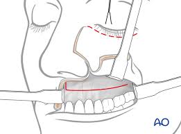 We did not find results for: Weber Ferguson Approach