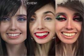 anorexic smile lines": what are these called?