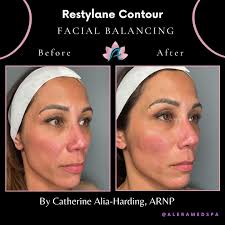 Achieve Facial Harmony with Restylane Contour at Alera Med Spa 😊 Discover  the transformative benefits of Restylane Contour for facial balancing at  Alera Medspa. Our clients have been delighted with their results,