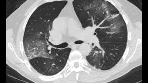 Lung cancer screening uses a type of chest computed tomography (ct), known as low radiation dose ct (ldct), using reduced doses of radiation doctors use lung cancer screening for early detection of disease in former and current smokers who do not have symptoms. The Radiology Assistant Covid 19 Imaging Findings
