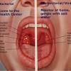 Sometimes, it can cause a palpable lump to form in the neck, although this symptom is not always present. 1